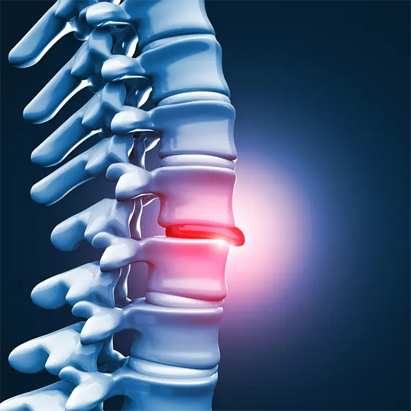 Disc Injury Treatment Near Me in Columbus, OH. Chiropractor For Disc Injury Treatment.