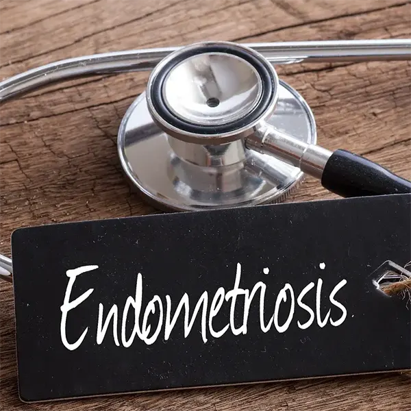 Endometriosis Treatment Near Me in Columbus, OH. Chiropractor For Endometriosis Pain Relief.